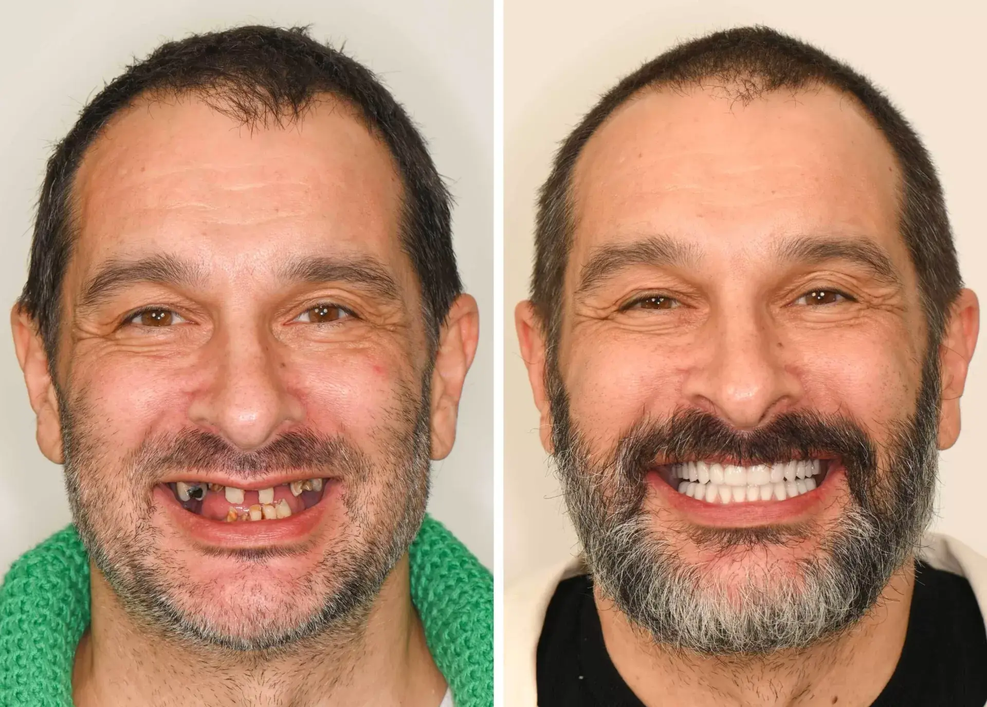 Michael T. after dental implant treatment